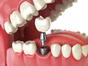 Bone Grafting Sunnyvale, CA