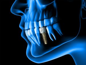 Dental Implants Sunnyvale, CA